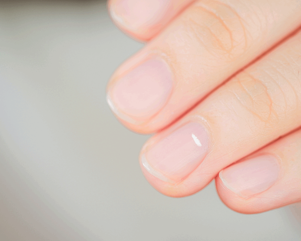 Unhas com manchas brancas sendo avaliadas por dermatologista em São Paulo