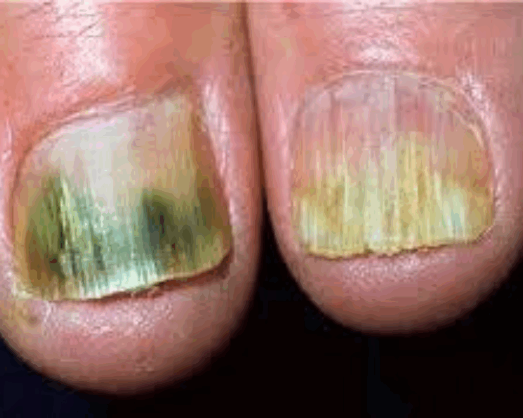 Unha inflamada sendo examinada por dermatologista especialista em líquen plano ungueal