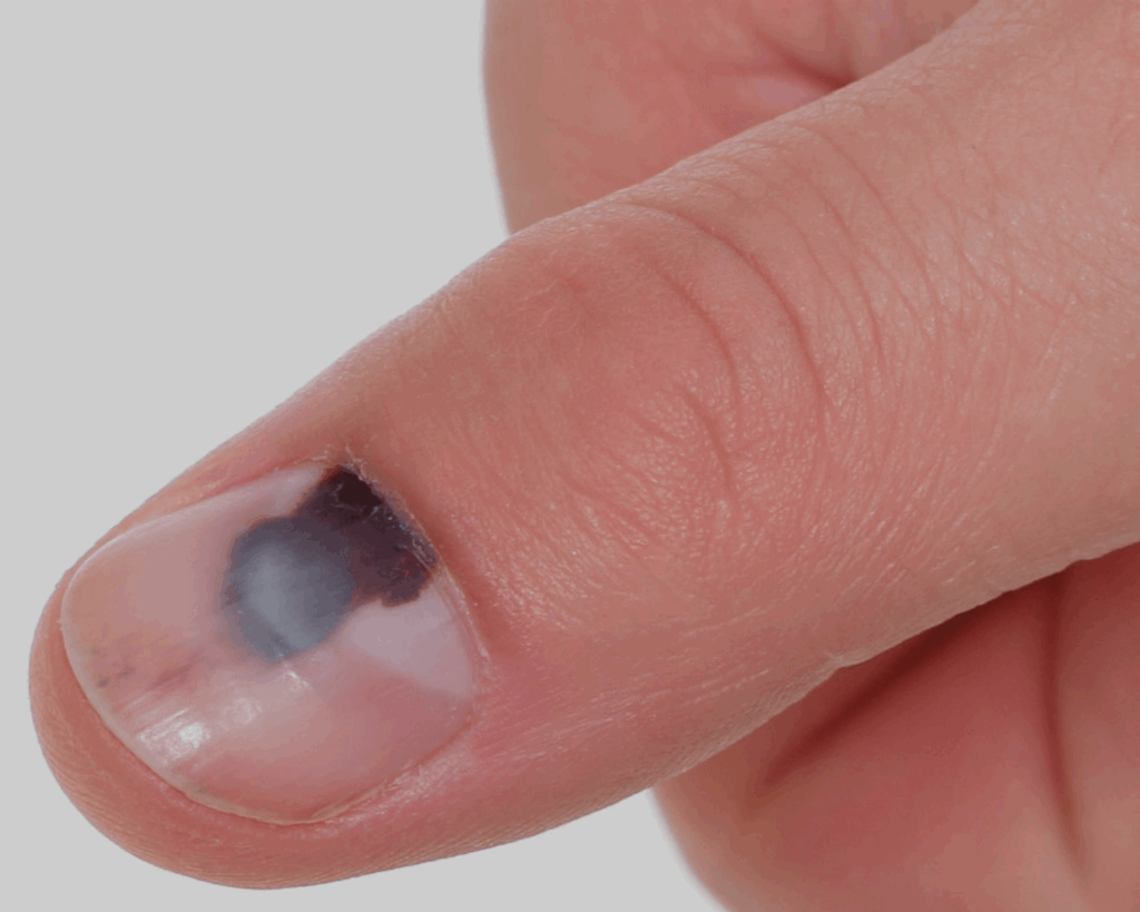 mancha de sangue visível sob a unha do dedão