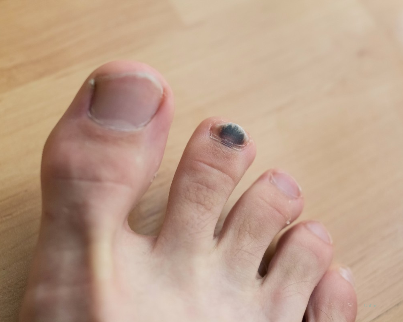 Mancha Escura na Unha