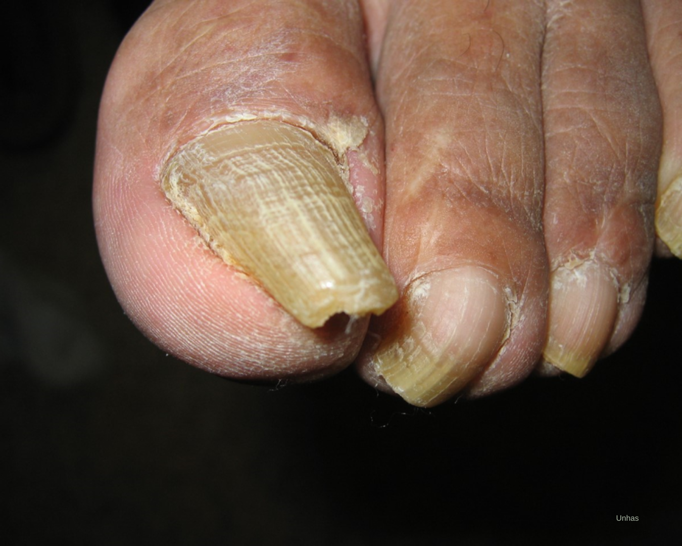 Onicogrifose UNGUEAL