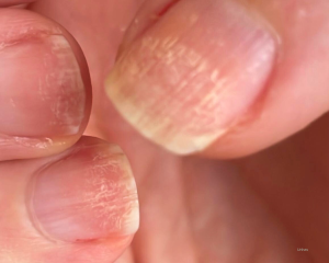 Unhas fracas e quebradiças