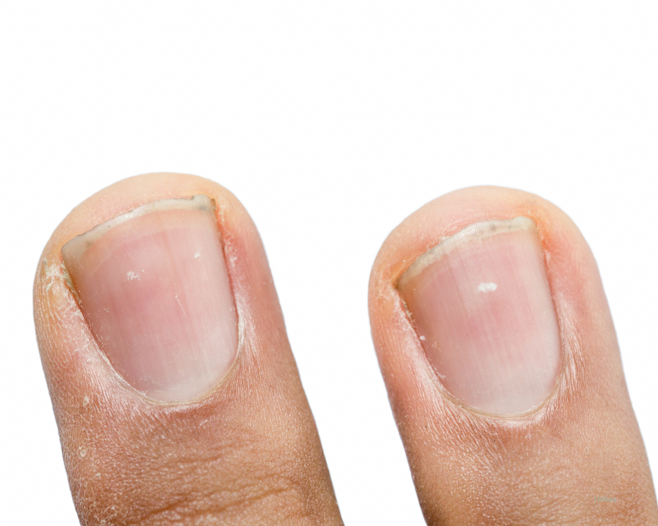 Manchas Brancas nas unhas
