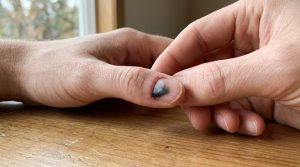 Mão inspecionando de perto uma unha com hematoma roxo visível sob a placa, transmitindo autocuidado.