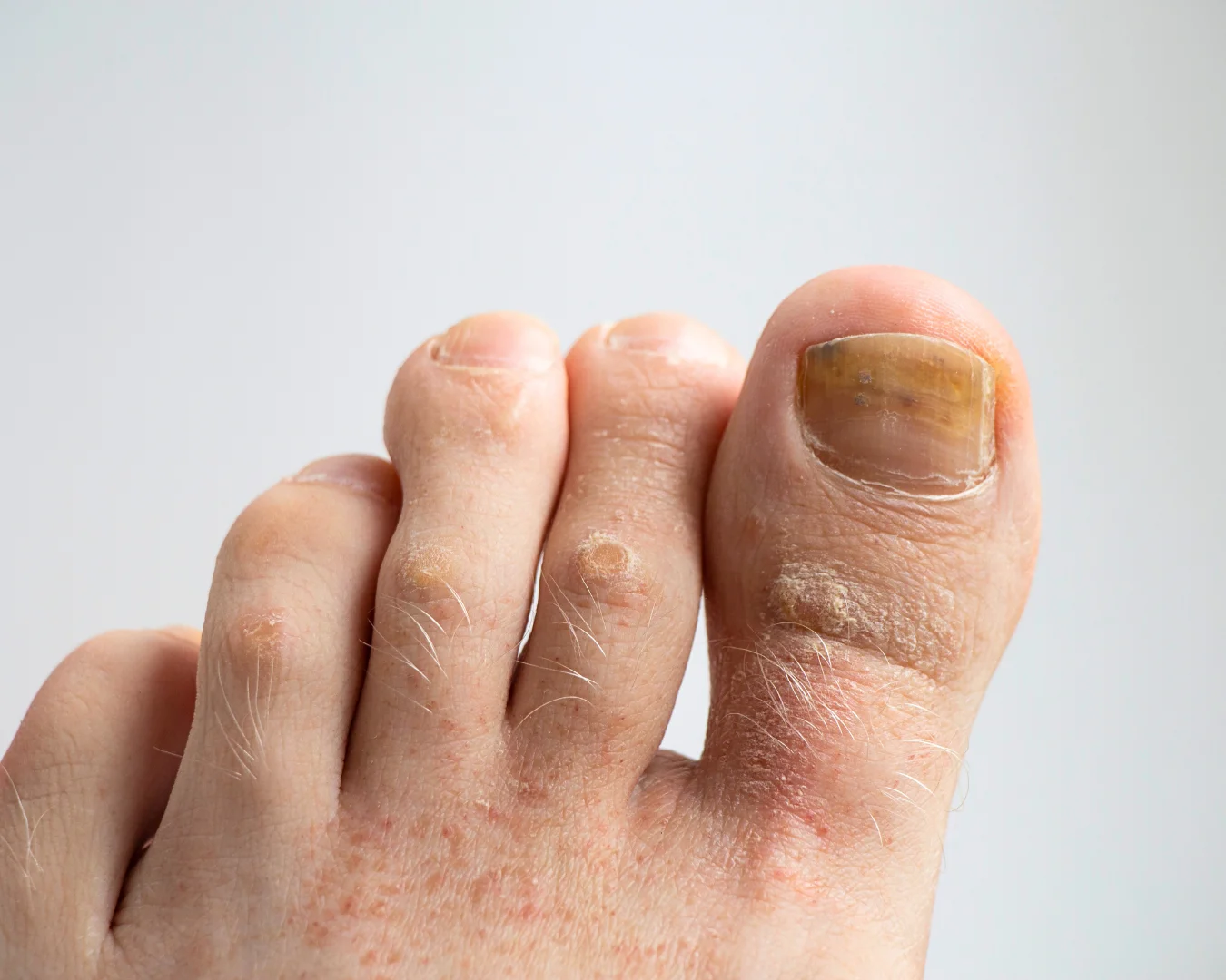 Tratamento de micose de unha por dermatologista em São Paulo