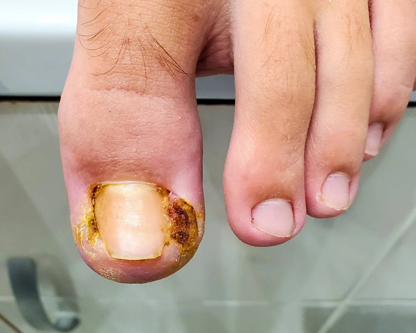 Tratamento de unha encravada por dermatologista em São Paulo