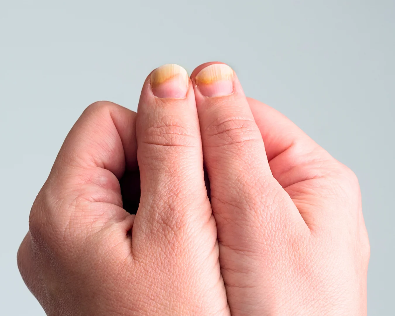 Unhas com psoríase sendo avaliadas por dermatologista em São Paulo