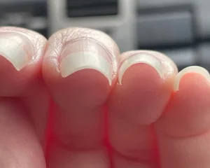 Hypercurvature in Nails