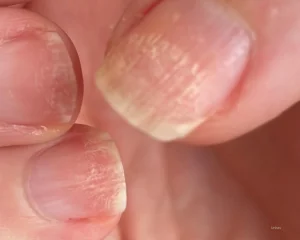 unhas quebradiças e fracas