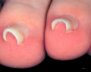 o que e unha em telha