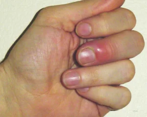 Doenças inflamatórias das unhas