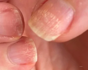 Unhas fracas e quebradiças