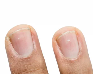 Manchas Brancas nas unhas