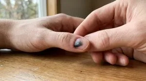 Mão inspecionando de perto uma unha com hematoma roxo visível sob a placa, transmitindo autocuidado.