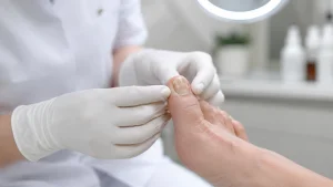 Avaliação dermatológica de unha do pé com alteração sugestiva de micose de unha em ambiente clínico.