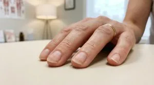 Mão feminina adulta com unhas ásperas, opacas e estriadas em close-up, em consultório dermatológico.